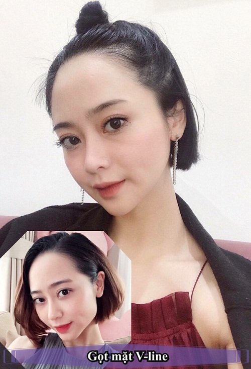 Bạn cần biết gì về phẫu thuật xương mặt?
